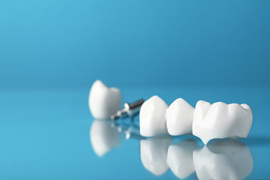 Get Your Smile Back in a Day: The Benefits of Same-Day Crowns at General & Cosmetic Dentistry of Tampa