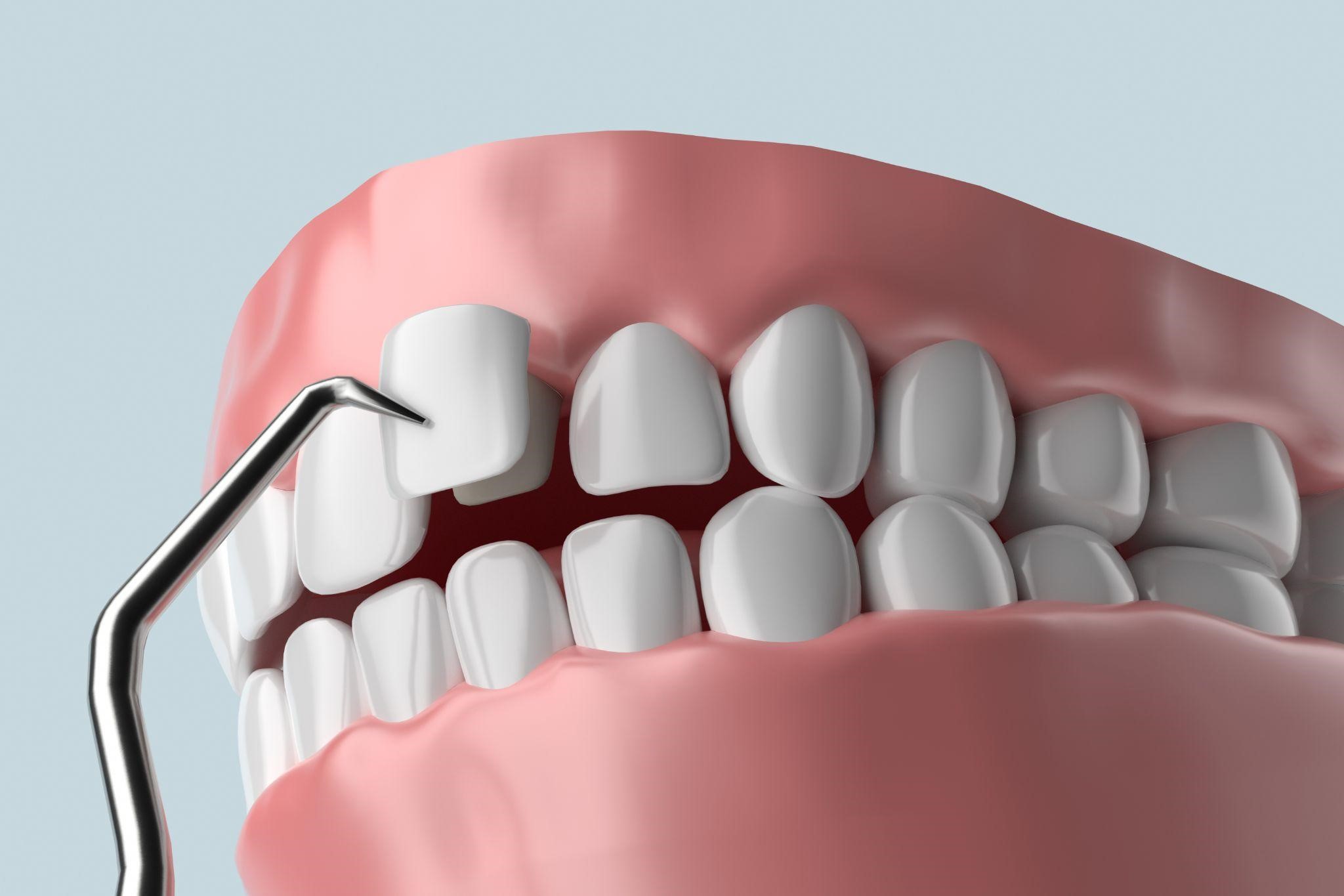 The Different Types of Veneers