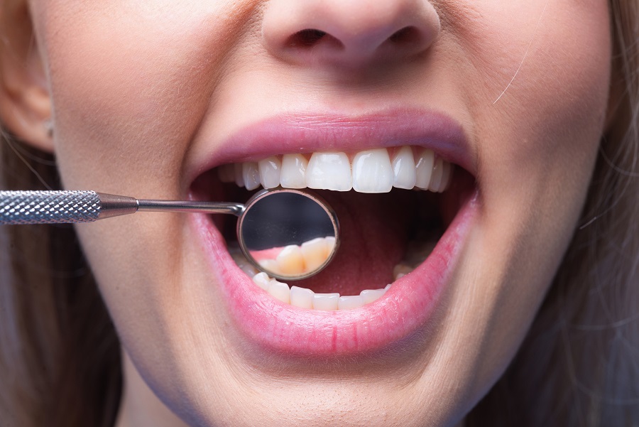 Common Questions About Teeth Whitening Answered by a Dentist